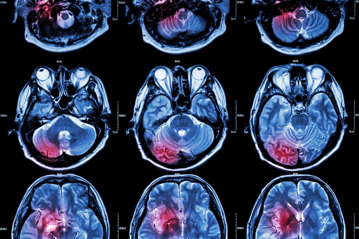 Novo tratamento para tumores cerebrais usando dispositivos bioelectrónicos