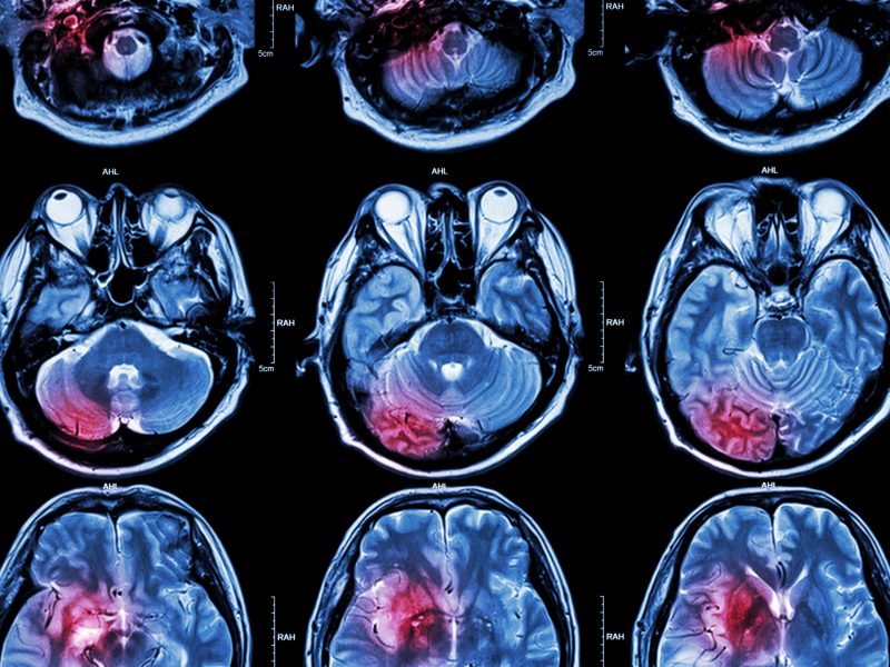 Novo tratamento para tumores cerebrais usando dispositivos bioelectrónicos
